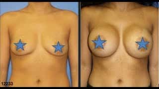 Silicone Versus Saline Implants