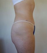 Abdominoplasty, Tummy Tuck NYC, after