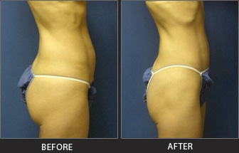 Abdominoplasty | before and after | Manhattan NYC
