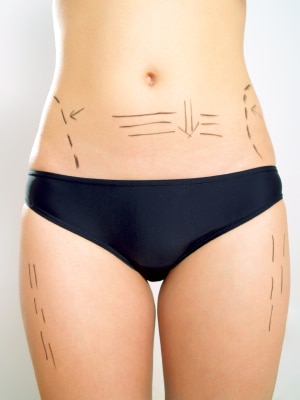 CoolSculpting and Gynecomastia