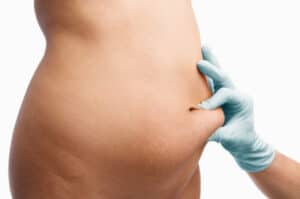 Picture of a patient's belly pre-liposuction surgery.