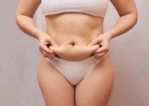 Liposuction results can take several weeks to become visible after surgery. 