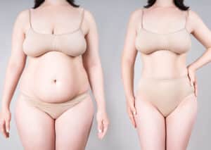 Abdominoplasty: The 3 Types of Tummy Tuck Procedures