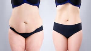 Abdominoplasty: The Three Types of Tummy Tuck Procedures