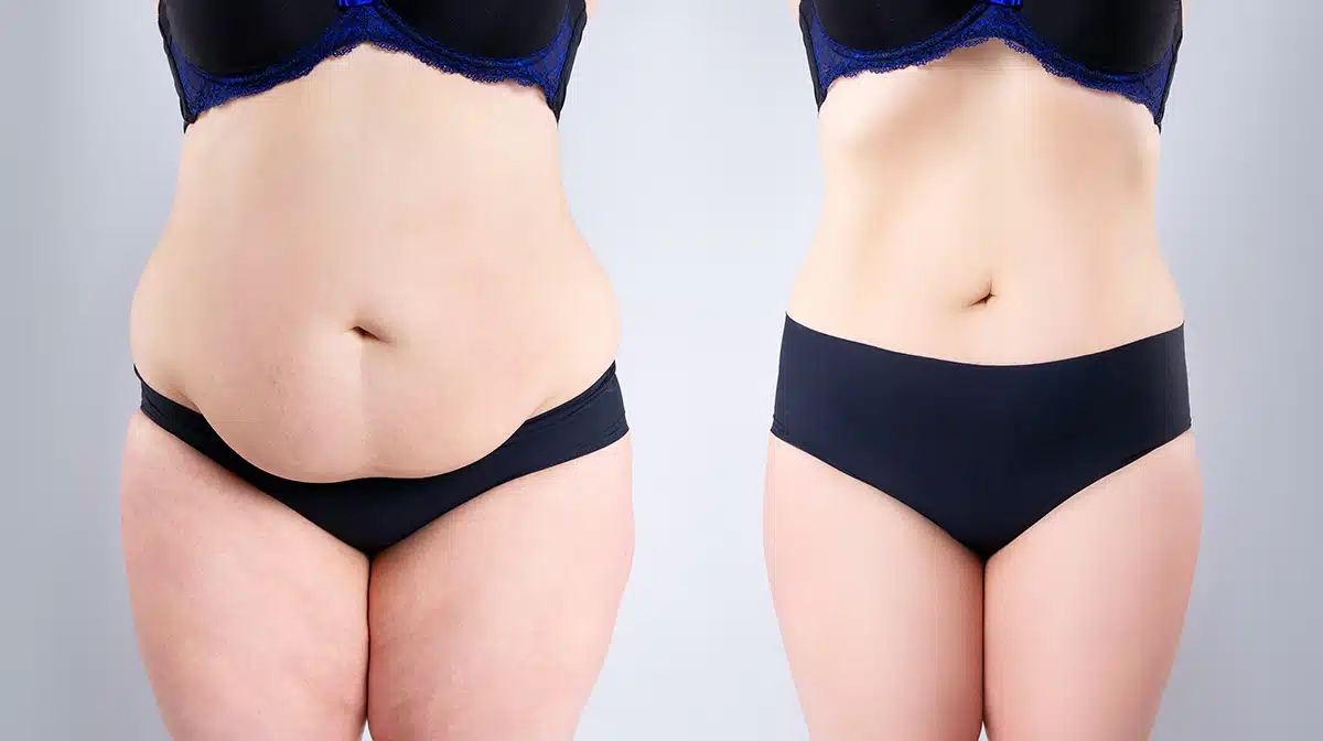 Abdominoplasty