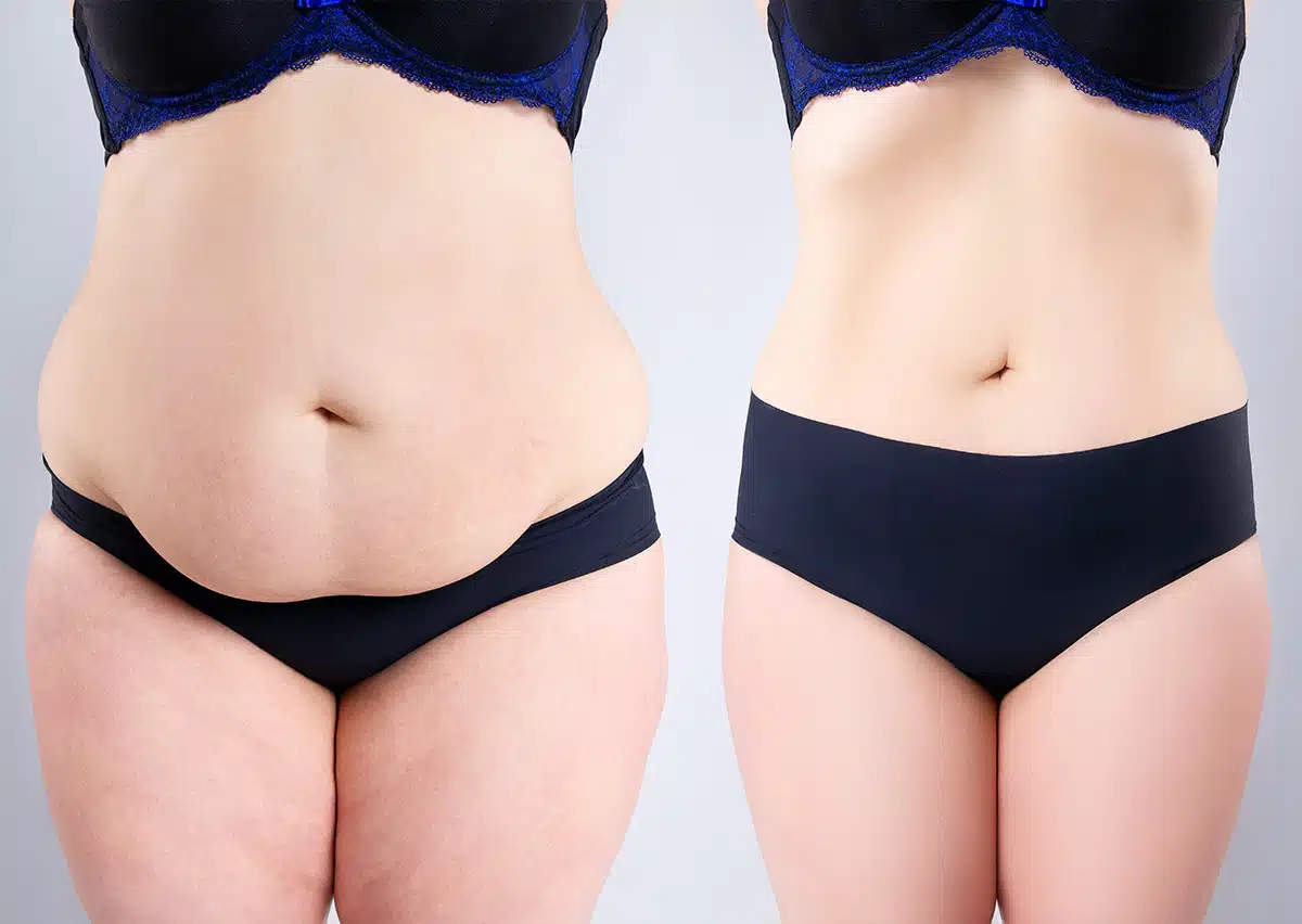 Do Tummy Tucks leave scars? Busting Abdominoplasty Myths