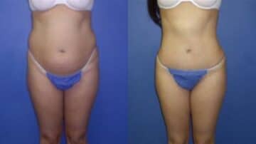 Tummy Tuck Before and After Photos in New York, NY, Patient 10536