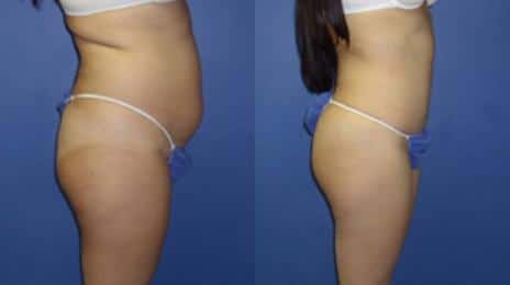 Tummy Tuck Before and After Photos in New York, NY, Patient 10536