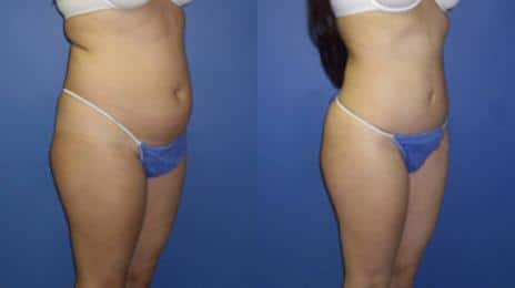 Tummy Tuck Before and After Photos in New York, NY, Patient 10536