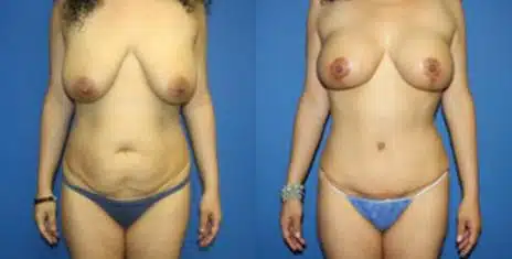 Tummy Tuck Before and After Photos in New York, NY, Patient 10540