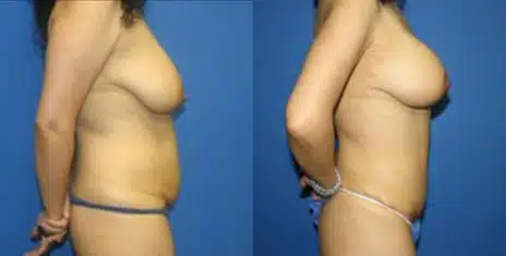 Tummy Tuck Before and After Photos in New York, NY, Patient 10540