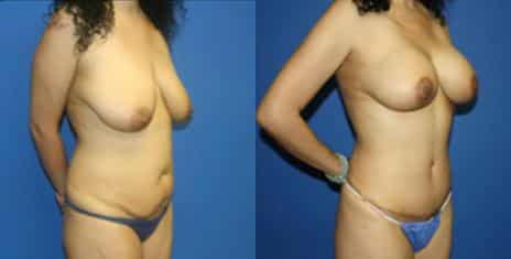 Tummy Tuck Before and After Photos in New York, NY, Patient 10540