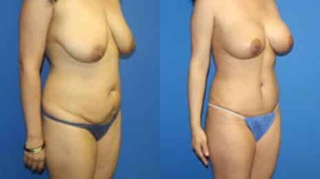 Tummy Tuck Before and After Photos in New York, NY, Patient 10540