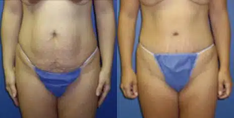 Tummy Tuck Before and After Photos in New York, NY, Patient 10545