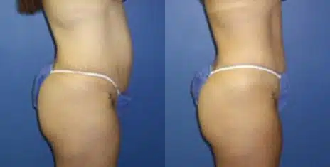 Tummy Tuck Before and After Photos in New York, NY, Patient 10545