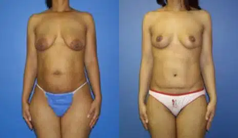 Tummy Tuck Before and After Photos in New York, NY, Patient 10556