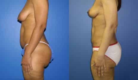 Tummy Tuck Before and After Photos in New York, NY, Patient 10556