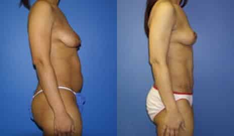 Tummy Tuck Before and After Photos in New York, NY, Patient 10556