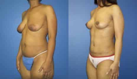 Tummy Tuck Before and After Photos in New York, NY, Patient 10556