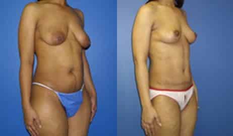 Tummy Tuck Before and After Photos in New York, NY, Patient 10556