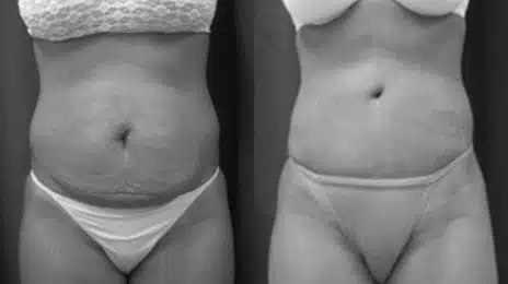 Tummy Tuck Before and After Photos in New York, NY, Patient 10562