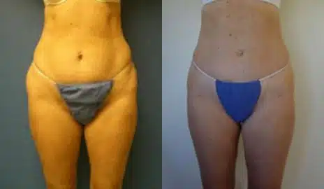 Tummy Tuck Before and After Photos in New York, NY, Patient 10565