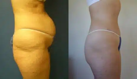 Tummy Tuck Before and After Photos in New York, NY, Patient 10565