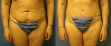 Tummy Tuck Before and After Photos in New York, NY, Patient 10568