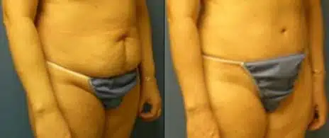 Tummy Tuck Before and After Photos in New York, NY, Patient 10568