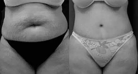 Tummy Tuck Before and After Photos in New York, NY, Patient 10571