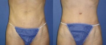 Tummy Tuck Before and After Photos in New York, NY, Patient 10579