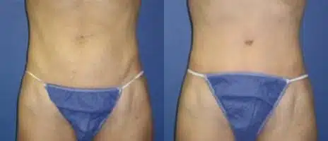 Tummy Tuck Before and After Photos in New York, NY, Patient 10579