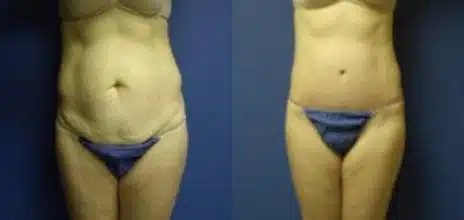 Tummy Tuck Before and After Photos in New York, NY, Patient 10581