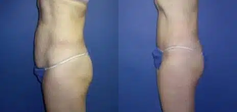 Tummy Tuck Before and After Photos in New York, NY, Patient 10581