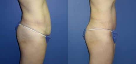 Tummy Tuck Before and After Photos in New York, NY, Patient 10581