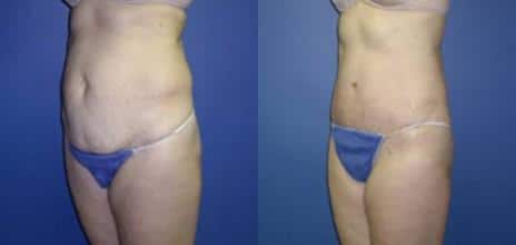 Tummy Tuck Before and After Photos in New York, NY, Patient 10581