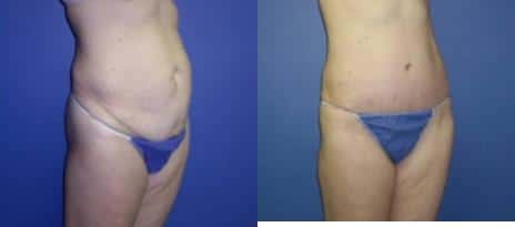 Tummy Tuck Before and After Photos in New York, NY, Patient 10581