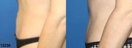 Tummy Tuck Before and After Photos in New York, NY, Patient 10594