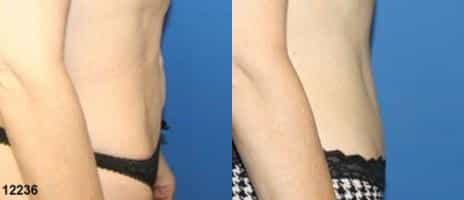 Tummy Tuck Before and After Photos in New York, NY, Patient 10594