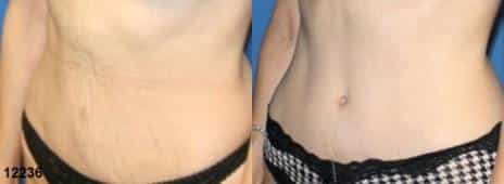 Tummy Tuck Before and After Photos in New York, NY, Patient 10594