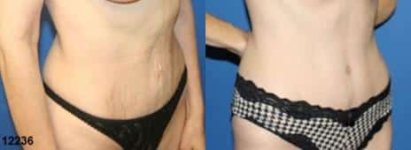 Tummy Tuck Before and After Photos in New York, NY, Patient 10594