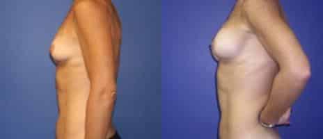 Breast Augmentation Before and After Photos in New York, NY, Patient 10760