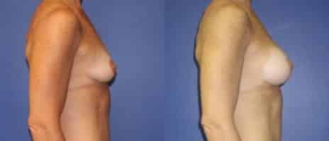Breast Augmentation Before and After Photos in New York, NY, Patient 10760