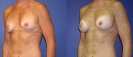 Breast Augmentation Before and After Photos in New York, NY, Patient 10760