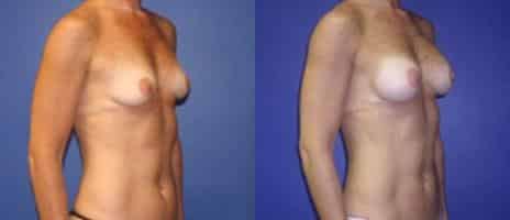 Breast Augmentation Before and After Photos in New York, NY, Patient 10760