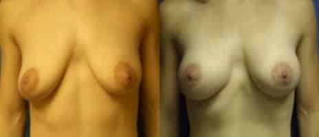 Breast Augmentation Before and After Photos in New York, NY, Patient 10765