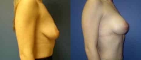 Breast Augmentation Before and After Photos in New York, NY, Patient 10765