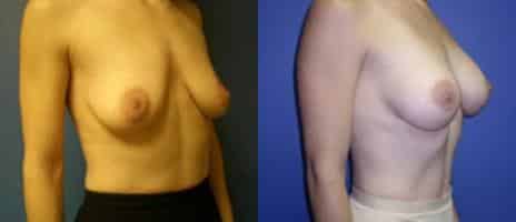 Breast Augmentation Before and After Photos in New York, NY, Patient 10765