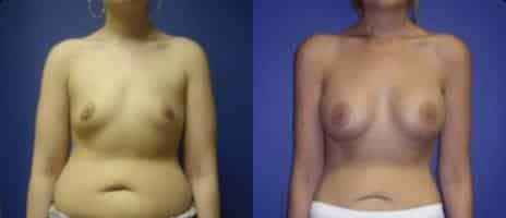 Breast Augmentation Before and After Photos in New York, NY, Patient 10769