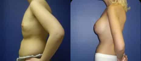 Breast Augmentation Before and After Photos in New York, NY, Patient 10769